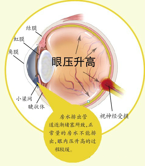 什么是青光眼？怎么治疗？