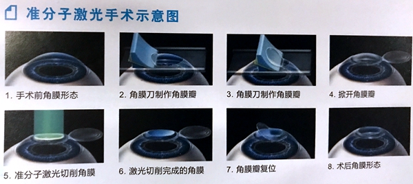 激光矫正近视眼已进入高科技时代