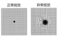 治疗黄斑病变要多少钱?