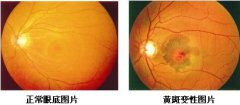 黄斑变性的治疗方法