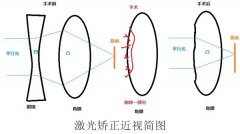 准分子近视手术好不好?有没有风险?